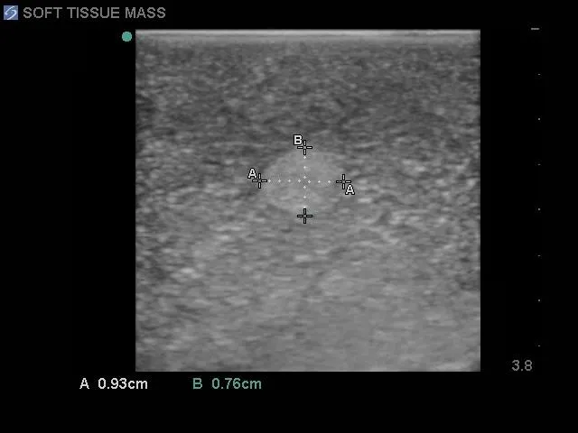 Soft Tissue Biopsy Ultrasound Training Block